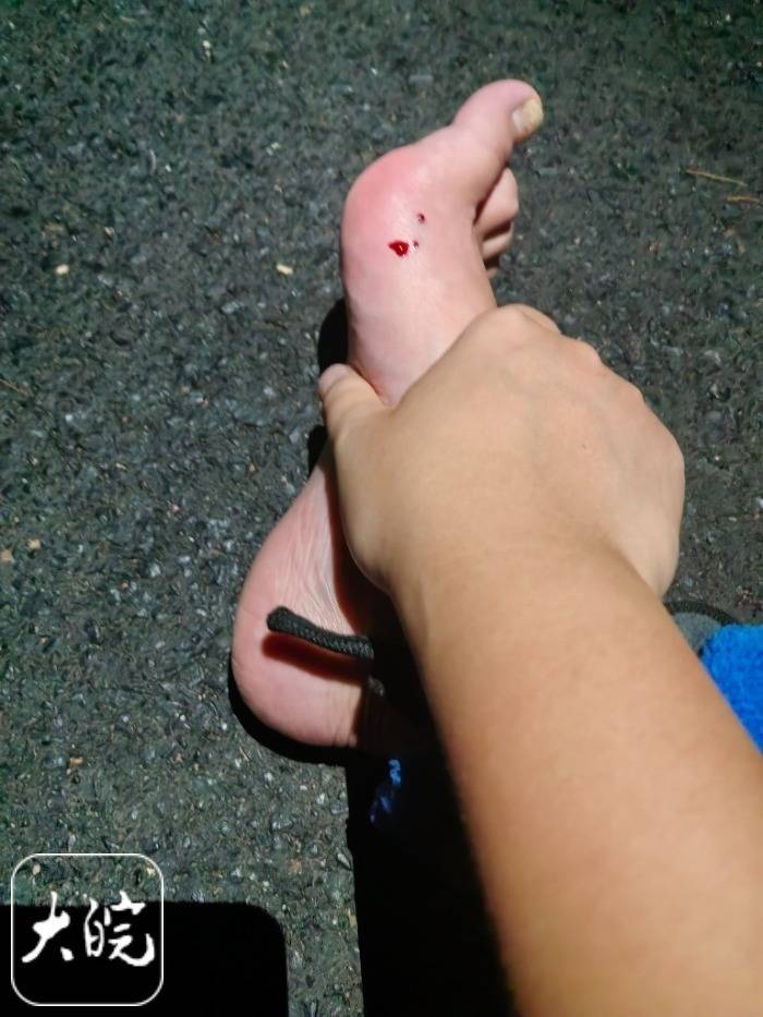 合肥一市民夜爬大蜀山被毒蛇咬伤 公园管理处呼吁:尽量避免夜间登山